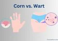 difference between Corn and Wart