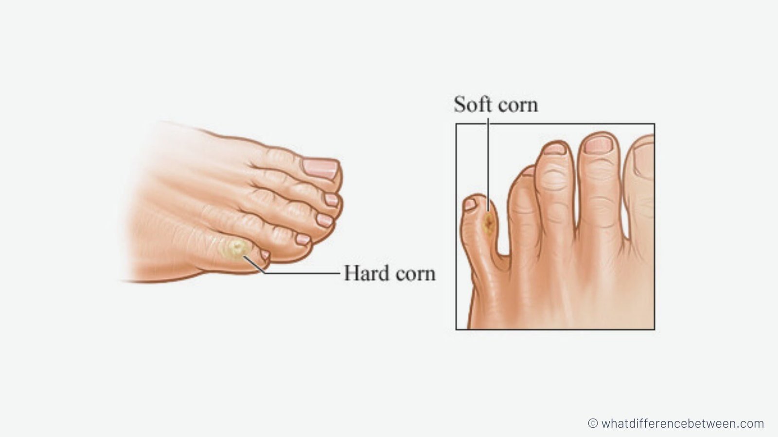 Corn vs Callus What's the Difference?