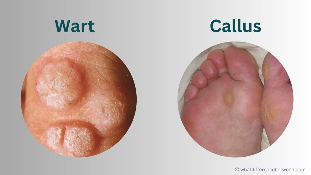 Wart vs Callus: What's the Difference?