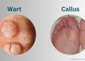 Wart vs Callus: What's the Difference?