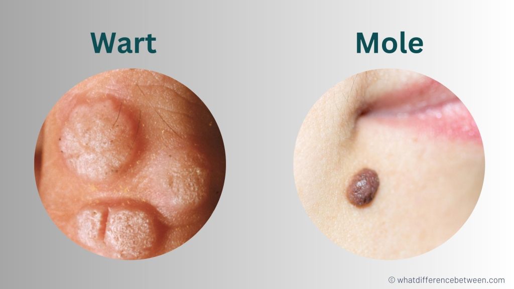 Wart vs Mole: What's the Difference?