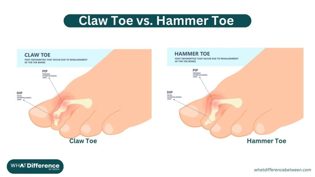 Claw Toe vs. Hammer Toe: Understanding the Differences