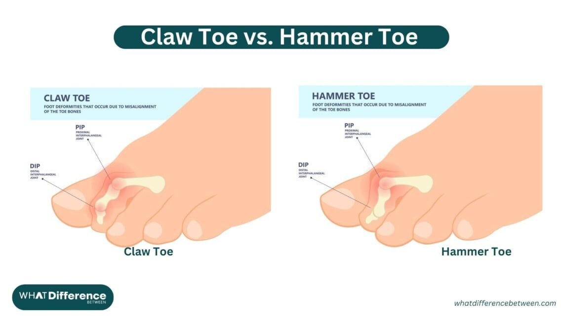 Claw Toe vs. Hammer Toe Understanding the Differences