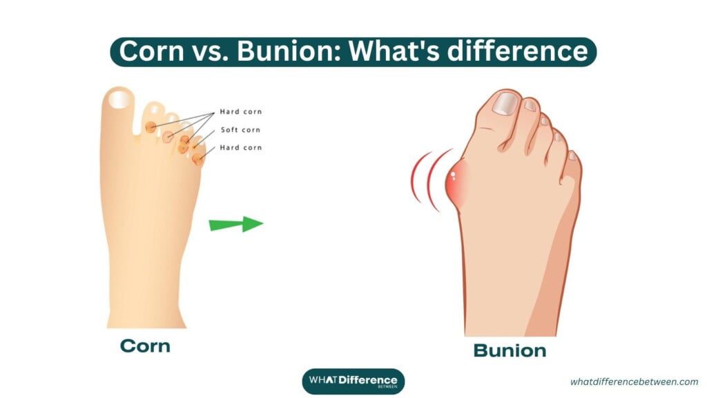 Corn vs Bunion: What's the Difference Between Corn and Bunion