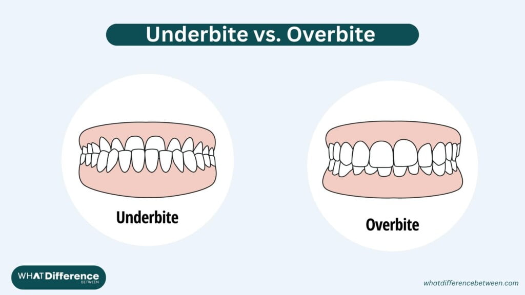 Underbite vs. Overbite; what's the difference, causes and treatment