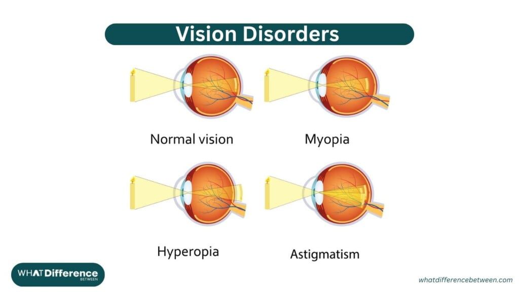 Vision Disorders: Astigmatism vs Myopia vs Hyperopia